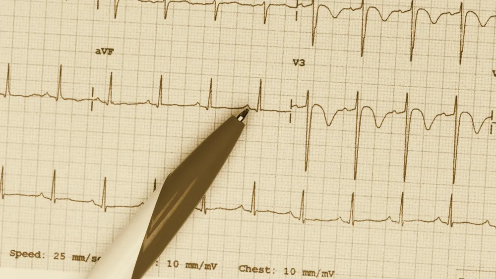An electrocardiogram tracing recorded on paper